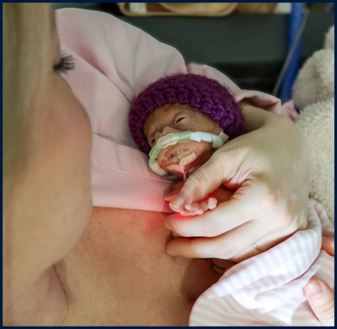 A mother holding her premature baby, who is receiving CPAP respiratory support